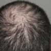 Hair Loss Men Treatment