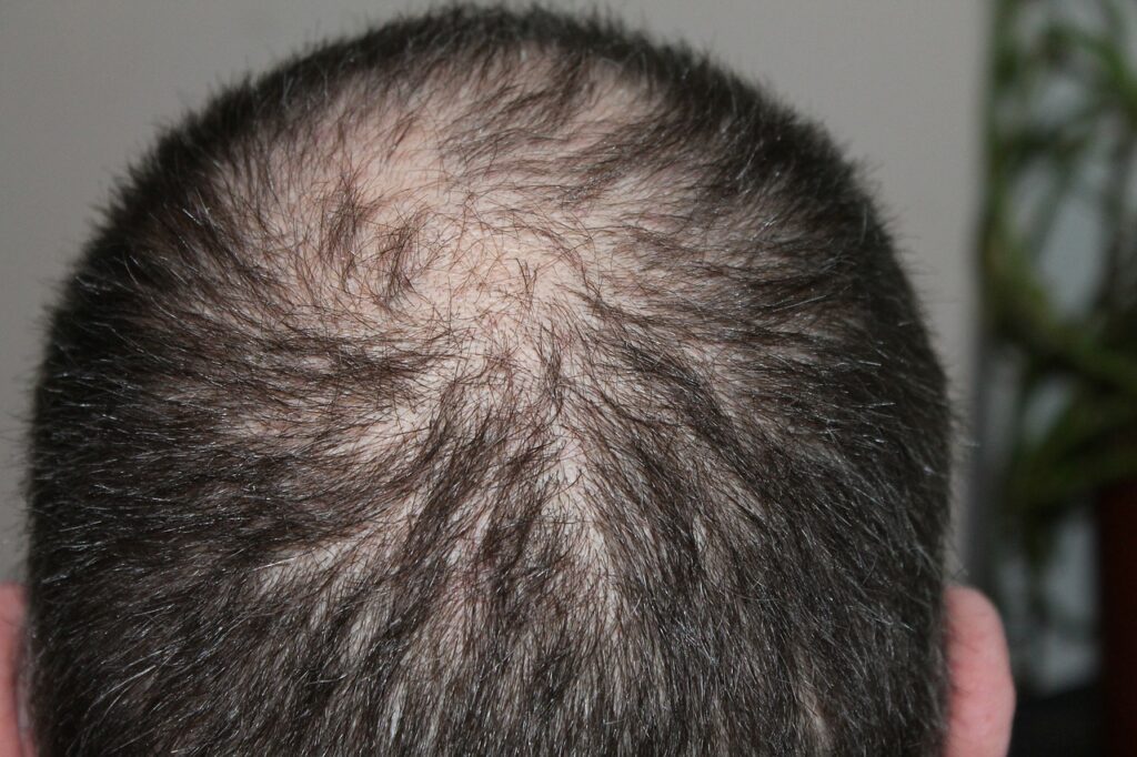 Hair Loss Men Treatment