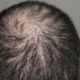 Hair Loss Men Treatment