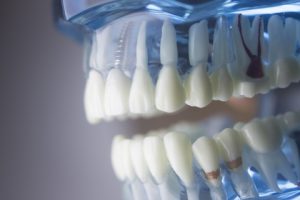 model of teeth and dental implant