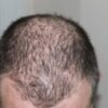 Good Hair Loss Treatment – Combat Your Hair Loss Problem