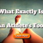 What Exactly Is An Athlete’s Foot – What Are The Indications