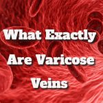 Veins Varicose What Exactly Are Varicose Veins