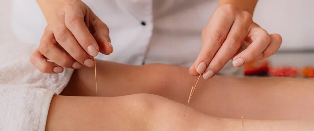 Acupuncture for Stress and Anxiety: A Clear Guide