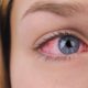 Eyelid Hygiene: Why It’s Essential for Eye Health