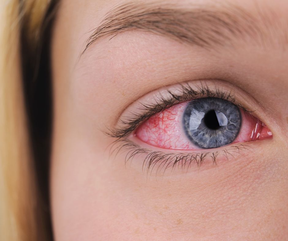Eyelid Hygiene: Why It’s Essential for Eye Health