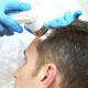 Hair Loss: More Common and Treatable Than You Realise