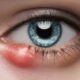 Eye Styes: Causes, Home Relief Tips and Optometrist Advice