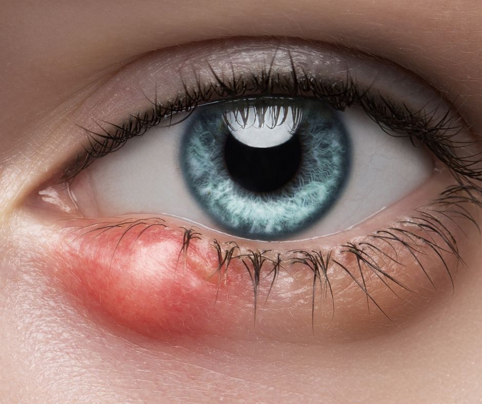 Eye Styes: Causes, Home Relief Tips and Optometrist Advice